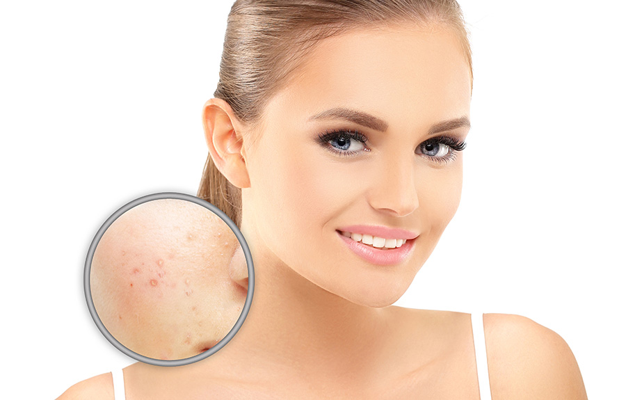 Traitement de l'acné | Site du Dr. Alina Elena ENACHE
